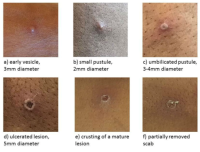 エムポックス（エムポックシー：サル痘）についての特集記事